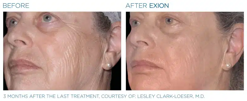 Exion-Before-and-After-Image-010
