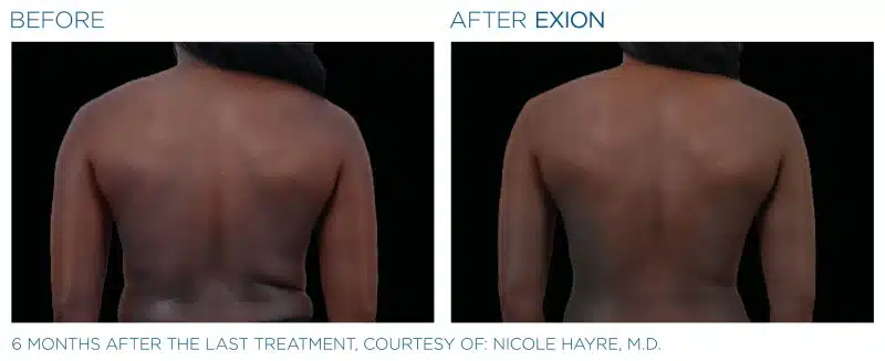 Exion-Before-and-After-Image-03