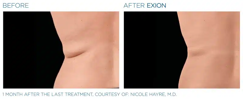 Exion-Before-and-After-Image-04