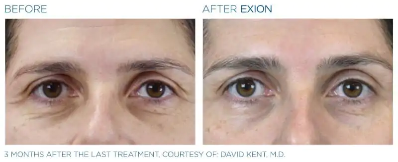 Exion-Before-and-After-Image-07