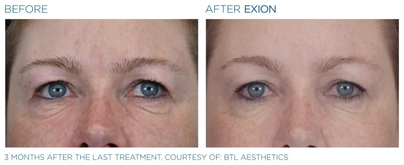 Exion-Before-and-After-Image-08