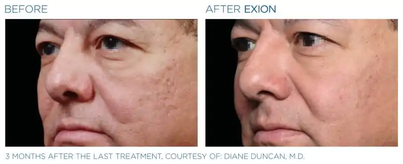 Exion-Before-and-After-Image-09