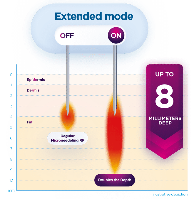 Exion_PIC_MOA_Fractional-RF_ENUS100